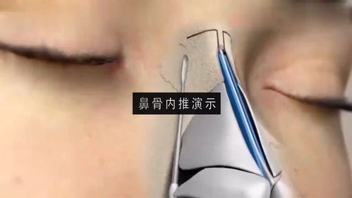 鼻骨内推效果明显吗