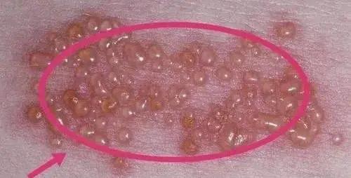 中医学对此病的病机早有认识,《外科正宗火丹》中记述:"火丹者
