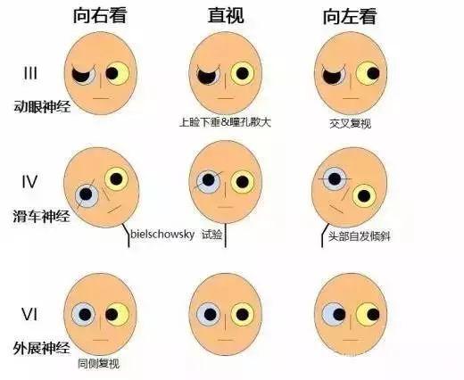 动眼神经滑车神经外展神经损伤的鉴别