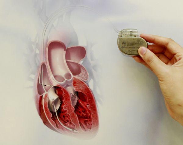 女童心脏埋起搏器 多种情况易晕厥甚至休克猝死