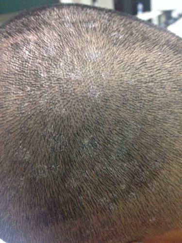 头上有这个像是头皮屑一圆块一圆块的 但用手扣又扣不掉 请问是什么?