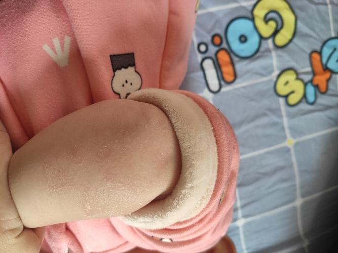 宝宝这是干性湿疹吗用什么药膏用了一回