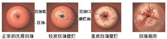 患上宫颈糜烂有哪些典型症状表现