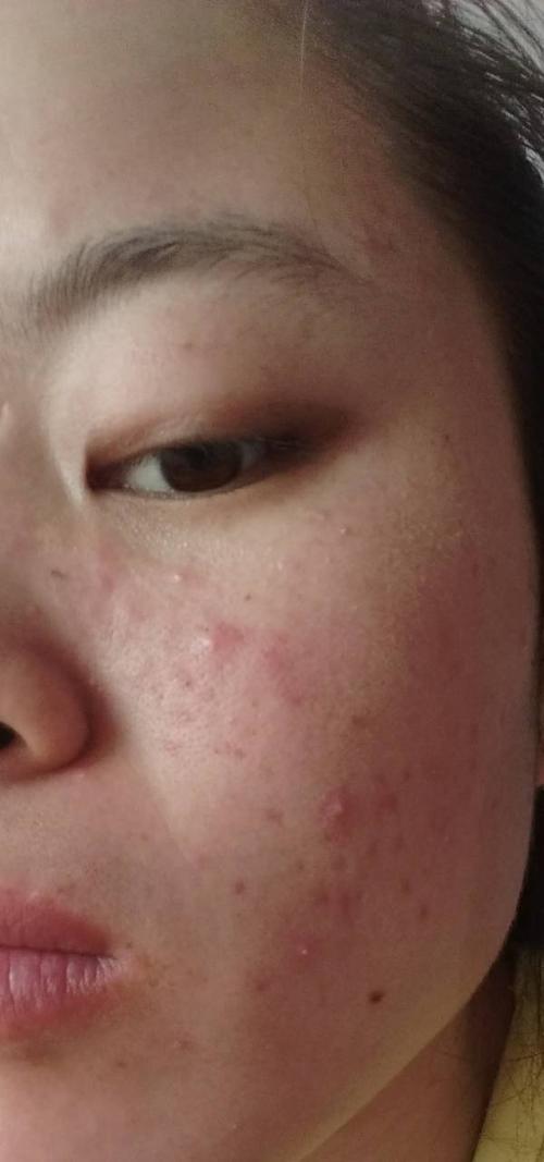 亲,最近脸上起了很多类似红色斑块的东西,随后就演变为红色小痘,先