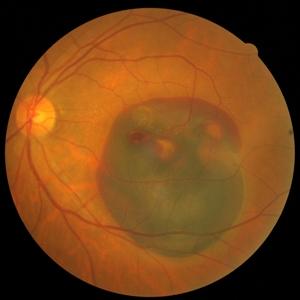 缓解老年性黄斑病食疗也可达到目的