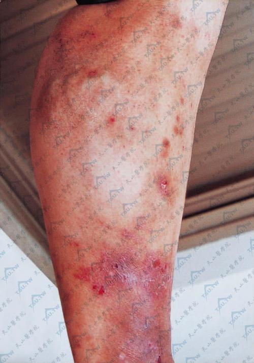 湿疹:病因,症状,诊断治疗详解