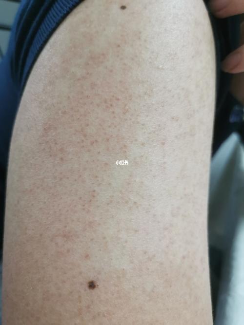 手臂后背特别多,皮肤粗糙很多疙瘩还有密密麻麻的小红点,请问有谁知道