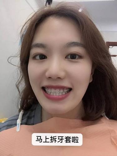 但是和大学时期比起来,反而觉得自己少女感倍增,这是摘牙套前一周的