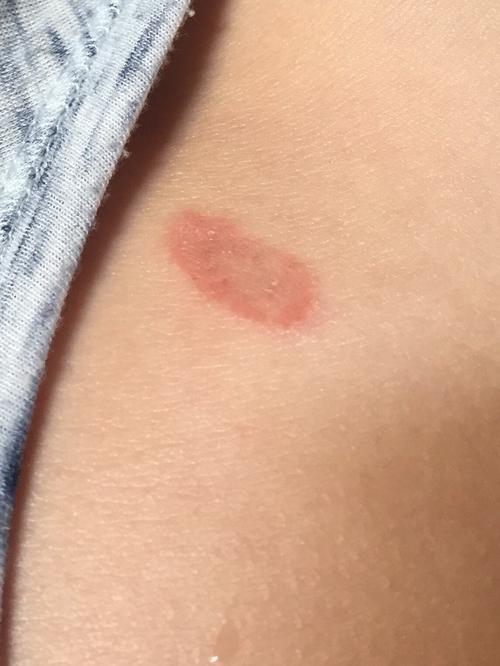 这是红斑狼疮吗?