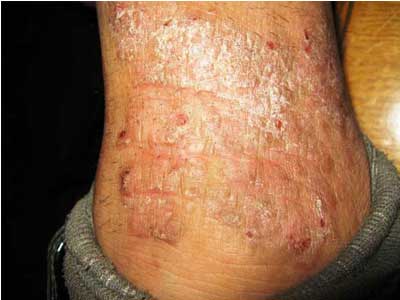 小腿湿疹发病有什么症状_湿疹_北京京城皮肤病医院