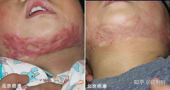 烧烫伤疤痕增生照射预防前后对比