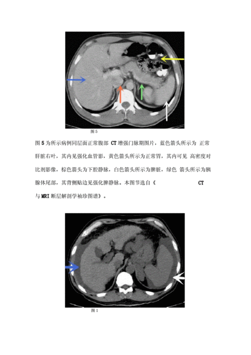 肝硬化ct诊断要点及鉴别诊断.docx 8页