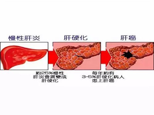 当乙肝患者有这6个症状时,说明可能已经发生了肝硬化