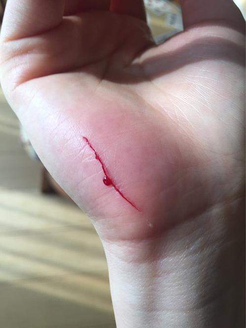 被猫抓破血了,需要打针吗