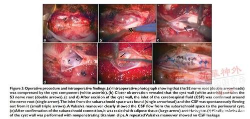 骶管囊肿文献导读:症状性骶管囊肿的囊肿切除和折叠缝合手术