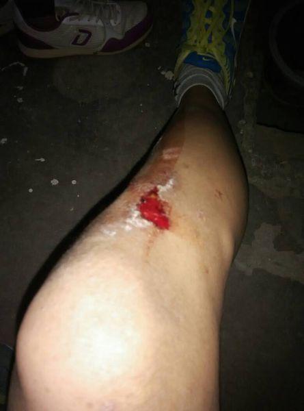 我腿上又快伤还没有还就摔倒了上面的甲摔掉了还能长上来吗?