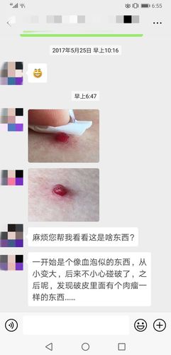 化脓性肉芽肿您了解吗?