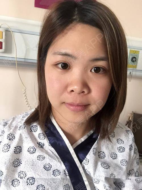 放我的术前照吧,完全没有你鼻梁就算了,鼻尖又塌也就算了,还朝天,基础