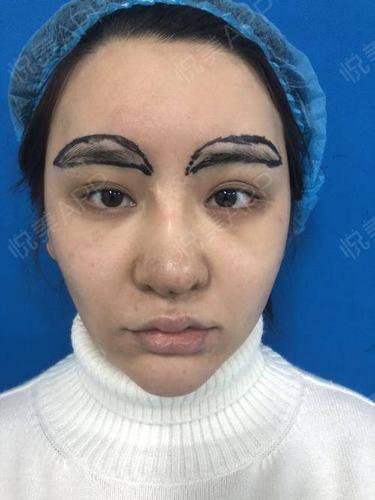假体垫眉弓术后1天_隆眉弓术后1天_面部轮廓术后1天_悦mer_9279712910
