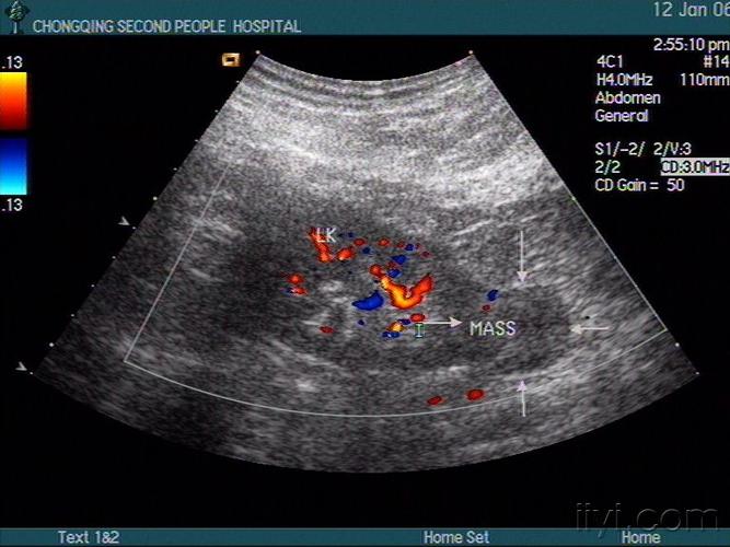 长不大的肾肿瘤 - 超声医学讨论版 - 爱爱医医学论坛
