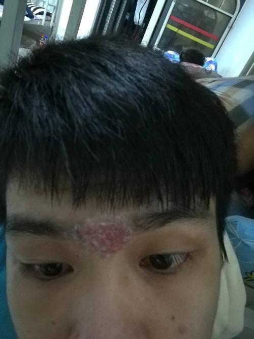前额皮肤烂了有两个半月了,一直流黄水和结痂,用了阿昔洛韦软膏一直没