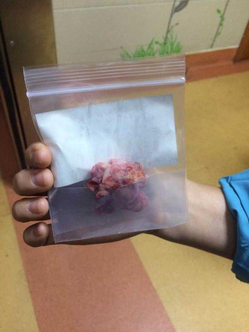 巧克力囊肿手术全记录及术后恢复情况是什么样的?