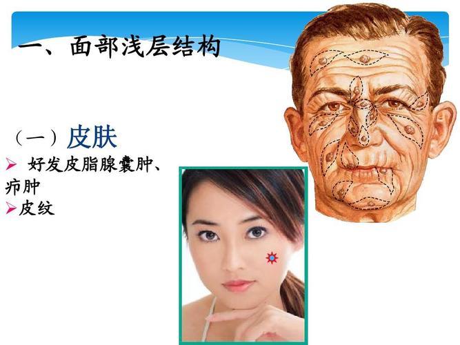 一,面部浅层结构 (一)皮肤   好发皮脂腺囊肿, 疖肿  皮纹