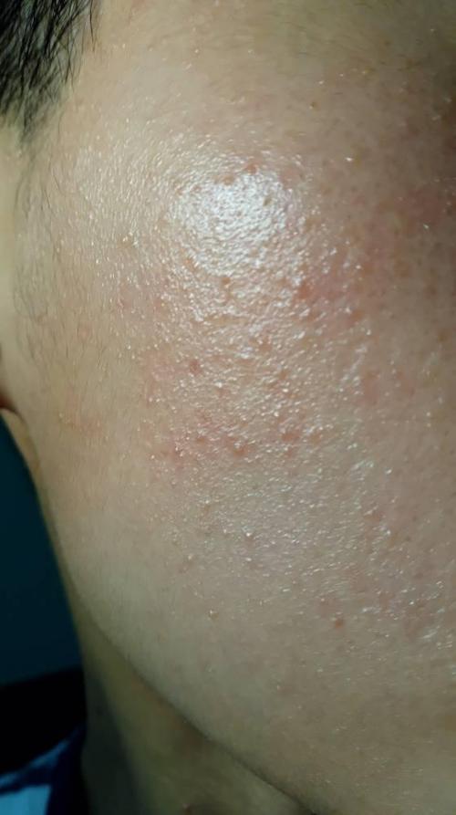 丘疹有人知道吗我脸上有很多密集的小丘疹 请问这个是不是丘疹呢 我