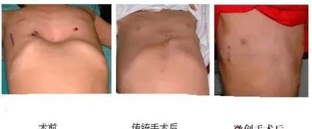 小儿鸡胸是佝偻病吗维生素d缺乏会引起小儿鸡胸吗对生长发育有哪些不