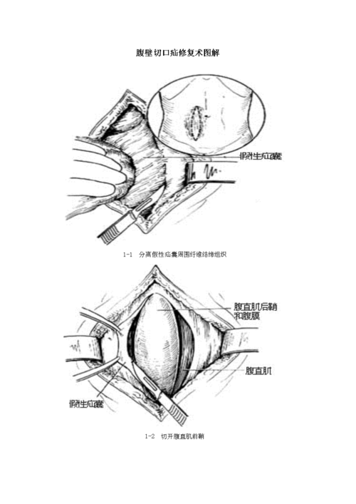 腹壁切口疝修复术图解.doc