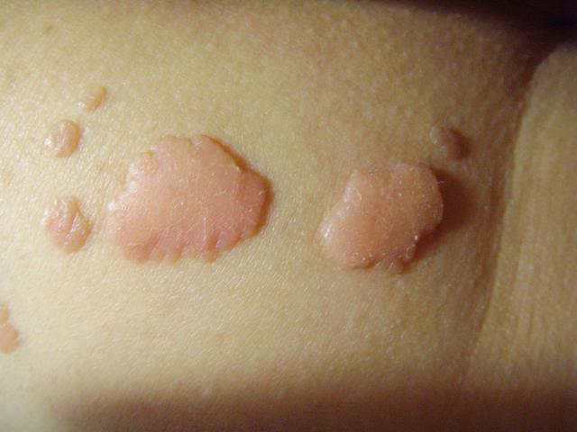 尖锐湿疣也会"伪装",私处长有小丘疹,别大意,或是感染hpv了