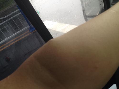 一般皮下包块有多种可能,如脂肪瘤,皮脂腺囊肿,皮下感染性包块如疖肿