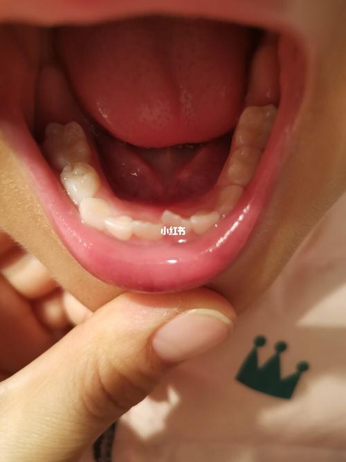 宝宝换牙,牙齿长歪了,需要到医院去矫正吗