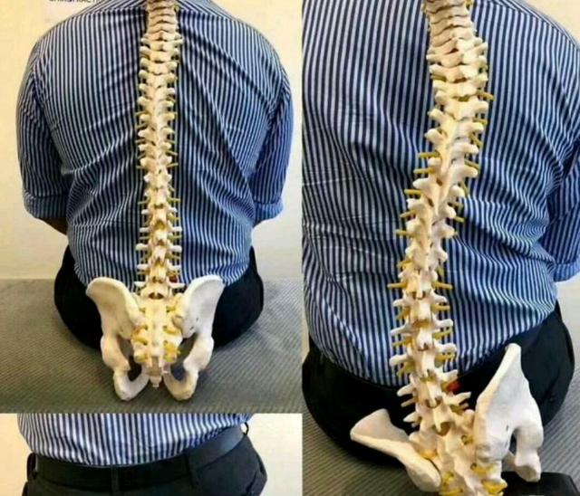 我们正常人的腰是弓形的,而古人指的水蛇腰是s型的,一种脊柱疾病