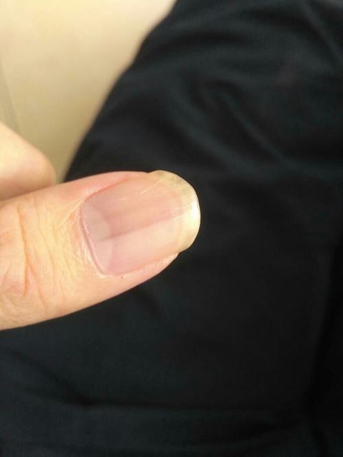我的左手拇指甲上的黑竖纹到底是什么回事?只有这只手指甲会.