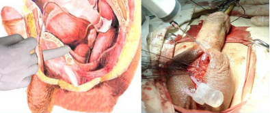 全面了解阴茎支撑体(假体)手术之二 ――手术方法简介