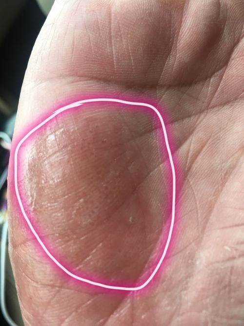 这是什么皮肤病手上长了一颗颗小水泡一样的斑点,时常发痒,有一两年