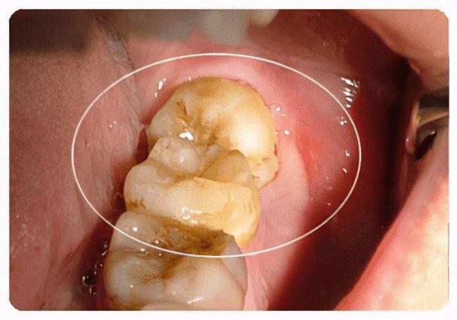 智齿拔不拔疼不疼拔牙费用拔牙后影响一次性说清楚