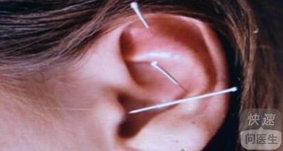 针灸如何治疗突发性耳聋 针灸2大穴位缓解耳聋症状