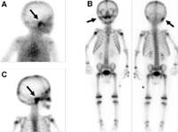 疑下肢骨髓炎骨扫描发现脑脓肿一例