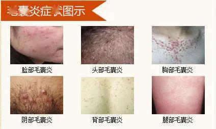 这四种人最易患毛囊炎!