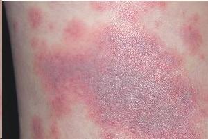 药疹多形红斑图片