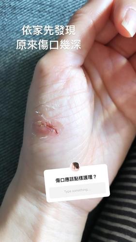 唐诗咏拍新剧手掌受伤 伤口深见肉让人心疼