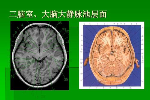 神经外科基础培训 三脑室,大脑大静脉池层面   37 4 35    32 31