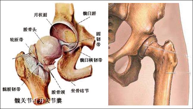 从而引起骨细胞进一步缺血,坏死,骨小梁断裂,股骨头塌陷的一种病变