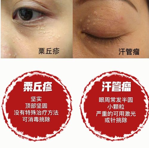 关于脂肪粒的那些事儿你知道多少内附案例分享