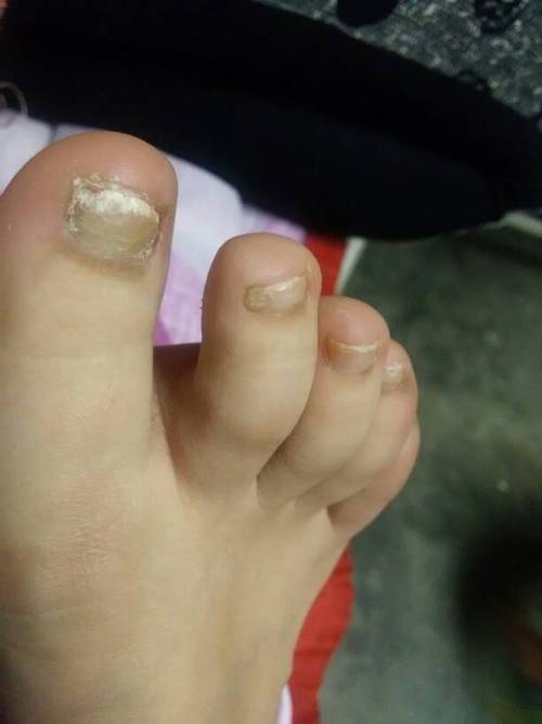 这种厚指甲怎么治疗?