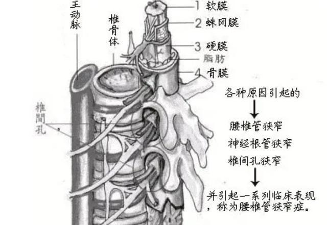 中医腰椎管狭窄如果不及时治疗后果