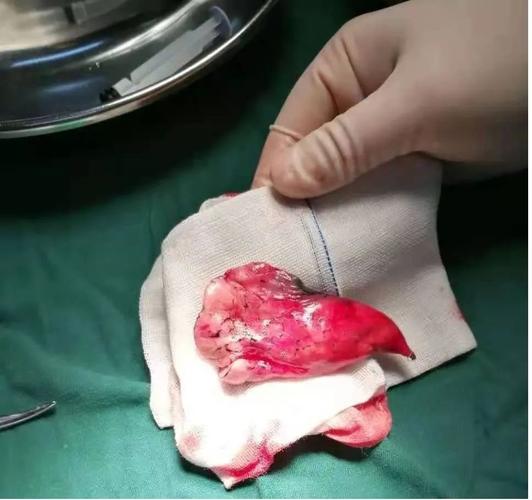 术中切除的肺部肿瘤