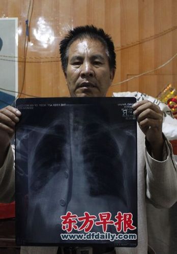 癌症村兴隆村村民,57岁的肺癌患者王建有向记者展示胸片.